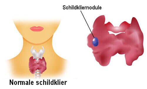 Nodule op de schildklier