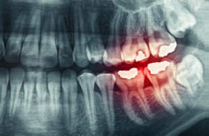 Oorzaken en gevolgen van tandenknarsen