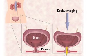 Urineverlies bestrijden met oefeningen