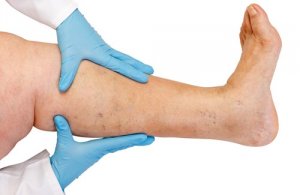 10 tips tegen vocht vasthouden