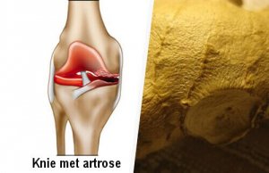 Zo elimineer je symptomen van artrose