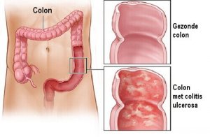Huismiddelen voor colitis ulcerosa