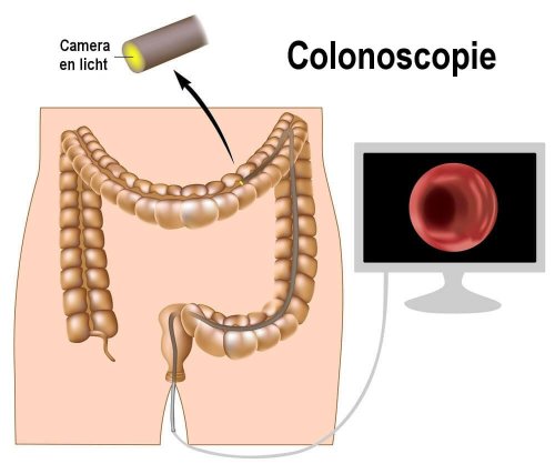 Colonoscopie