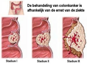 Wat je moet weten over darmkanker