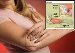 Hoe behandel je peesontsteking (tendinitis)