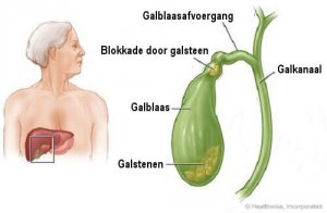 Hoe weet je of je galstenen hebt?
