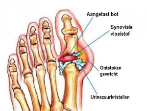 Urinezuurkristallen verwijderen op natuurlijke wijze