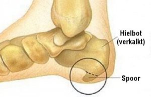 Hielspoor: symptomen en behandeling