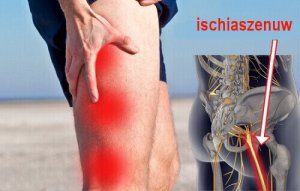 Natuurlijke huismiddelen voor ischias