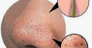 Puistjes en mee-eters bestrijden op natuurlijke wijze