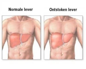 Is jouw lever ontstoken?