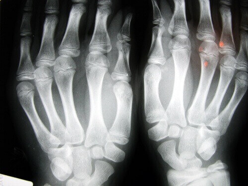 röntgenfoto artritis handen