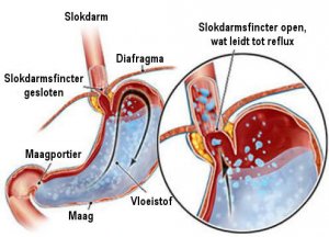 Brandend maagzuur stoppen