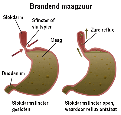 Reflux