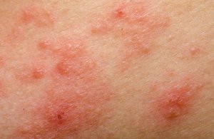 Rosacea onder controle houden