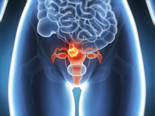 Endometriose als reden voor een onregelmatige menstruatiecyclus