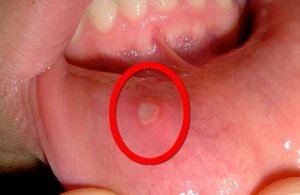 Huismiddelen om aften te bestrijden