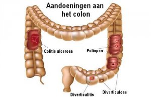 Het colon beschermen tegen veelvoorkomende aandoeningen