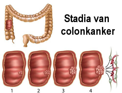 Stadia van Colonkanker