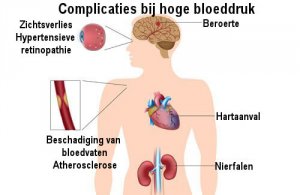 De beste manieren om hoge bloeddruk te bestrijden