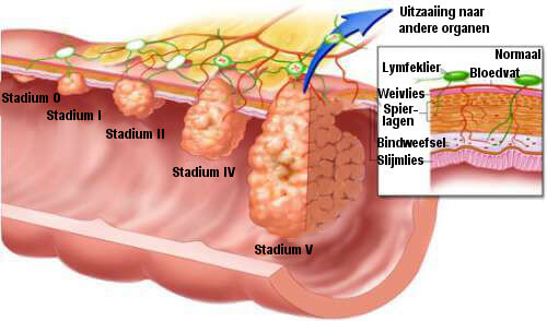 Tekening van de stadia van darmpoliepen