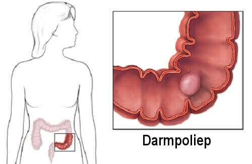 Enkele feiten over darmpoliepen