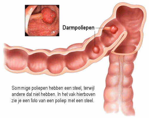 Darmpoliep met steel