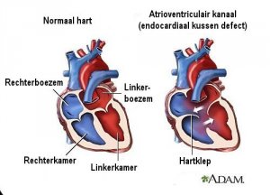 7 symptomen van hartruis die je moet kennen