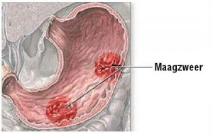 Symptomen van maagzweren