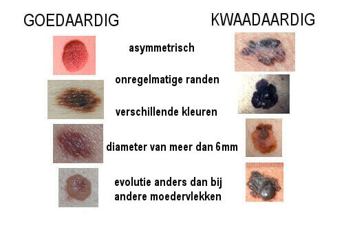 Goedaardige en kwaadaardige moedervlekken