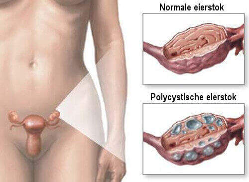 Remedies voor polycysteus-ovariumsyndroom