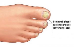 Huismiddelen om schimmelinfecties te elimineren