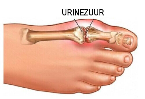 Urinezuur