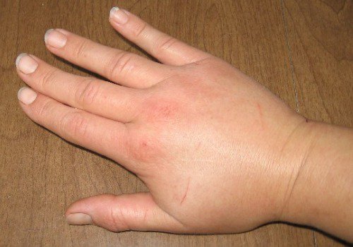 Vocht in een hand
