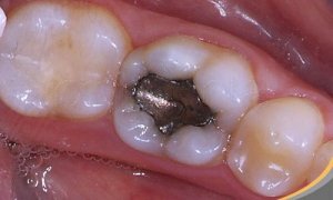 Amalgaamvullingen: wat zijn de gezondheidsrisico’s?