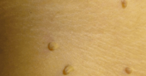 10 natuurlijke remedies om wratten te verwijderen