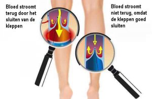 De bloedcirculatie in je armen en benen verbeteren