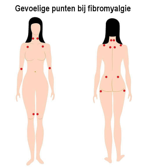Gevoelige Punten bij Fibromyalgie