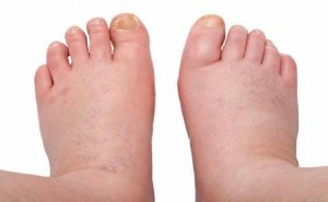 6 remedies tegen zwelling in de voeten en benen