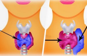 Het verschil tussen hypothyreoïdie en hyperthyreoïdie