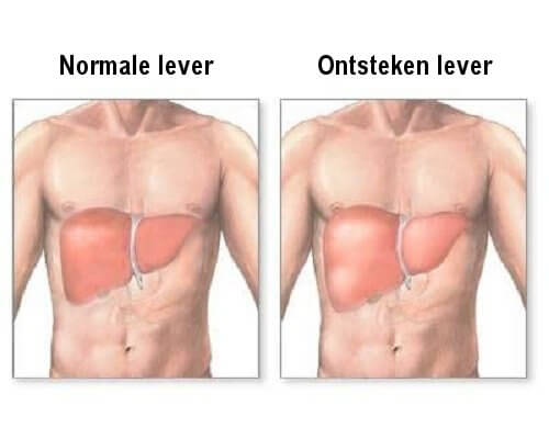 Leverontsteking: symptomen en een goed dieet Leverontsteking: symptomen en een goed dieet