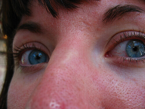 mee-eters in het gezicht