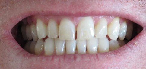 Gevolgen van tandenknarsen
