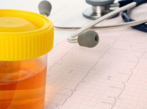 Veranderingen in de urine een van de symptomen van kanker