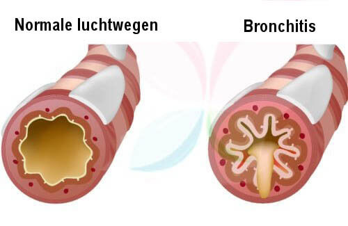 Wat is de oorzaak van hoest bij kinderen