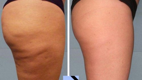 Makkelijke zelfgemaakte cellulitebehandelingen Makkelijke zelfgemaakte cellulitebehandelingen