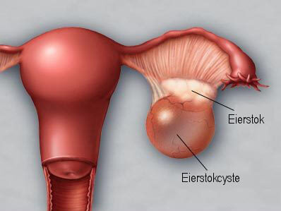 Eierstokcyste en eierstok