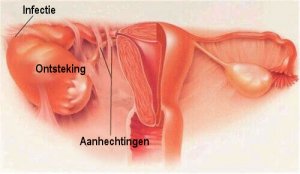 Symptomen van een eileiderontsteking