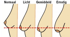 5 gewoontes waardoor je borsten gaan hangen