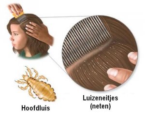 5 huismiddeltjes tegen hoofdluis